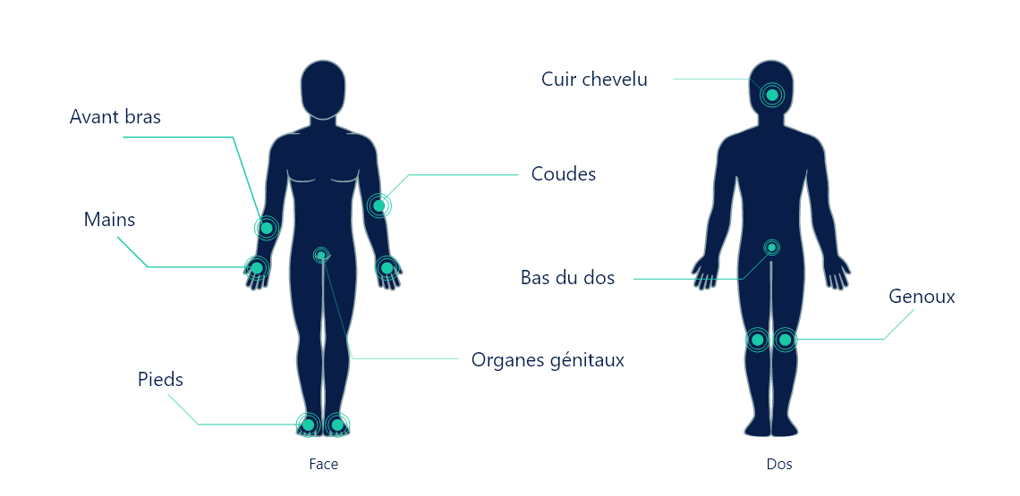 Principales localisations du psoriasis en plaques: avant bras, mains, pieds, organes génitaux, coudes, cuir chevelu, bas du dos, genoux, dos.